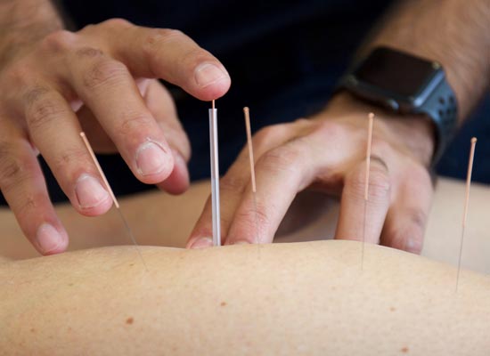 dry-needling